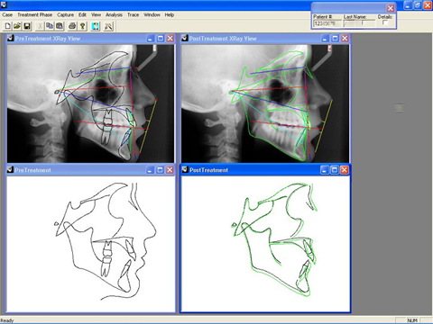 before and after ortho